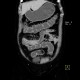 Crohn's disease of neoterminal ileum, ileocecal resection: CT - Computed tomography